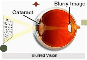 A picture of an eye with blurry vision and cataract.